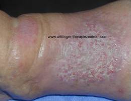 papillomatosis in lymphedema