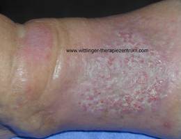 Papillomatosis immunitás - Papillomatosis és lymphedema